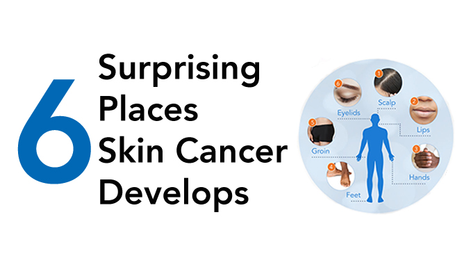 6 Surprising Places Skin Cancer Develops