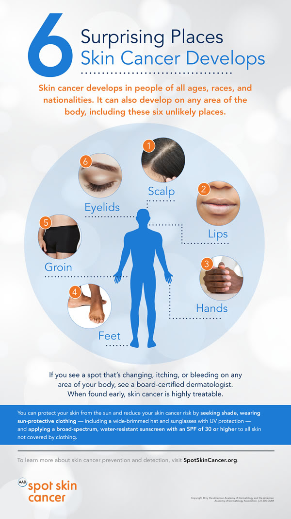 May is Skin Cancer Awareness Month