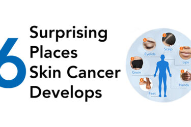 6 Surprising Places Skin Cancer Develops|May is Skin Cancer Awareness Month
